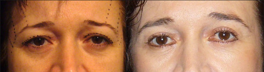Upper and lower blepharoplasty before and after, showing removal of excess eyelid skin and refreshed eye contour