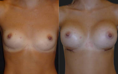 Before and after breast augmentation with silicone implants showing improved cleavage and lifted appearance