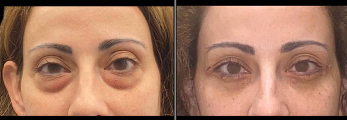 Blepharoplasty 71