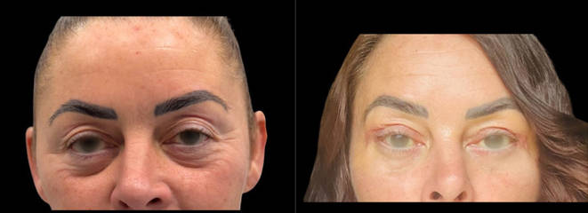 Blepharoplasty 72