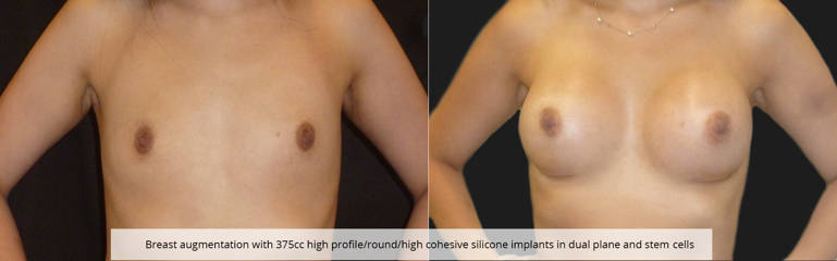 Breast augmentation before and after, with 375cc high profile silicone implants in dual plane and stem cells