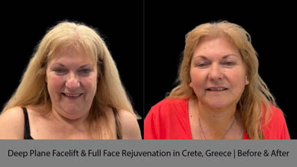 Deep Plane Facelift & Full Face Rejuvenation in Crete, Greece, Before & After