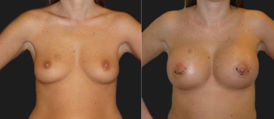 Before and after breast augmentation showing increased volume and enhanced breast shape