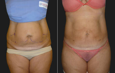 Before and after abdominal liposuction showing smoother contour and reduced excess fat