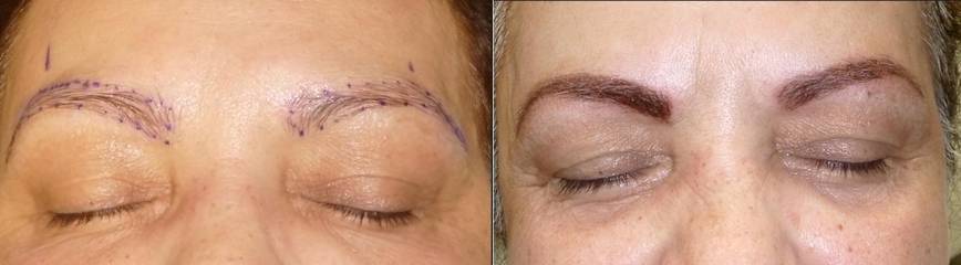 Before and after micropigmentation eyebrow treatment showing precise pigment application for natural looking brows
