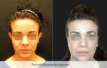 Before and after otoplasty showing correction of upper ear projection for improved symmetry and natural shape