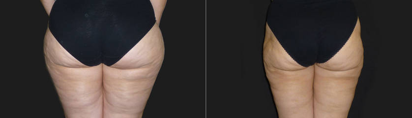 Before and after liposuction on thighs and buttock showing smoother skin and reduced volume