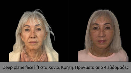 Deep plane face lift in Chania, Crete. Before/after 4 weeks