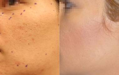 Before and after laser resurfacing showing smoother skin texture and reduced surface imperfections