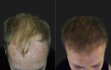 Before and after hair transplantation showing marked improvement in hairline definition and overall scalp fullness