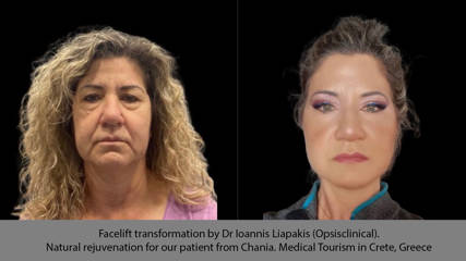facelift-chania-liapakis-opsisclinical-medical-tourism-greece