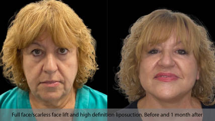 Full Scarless Facelift 11