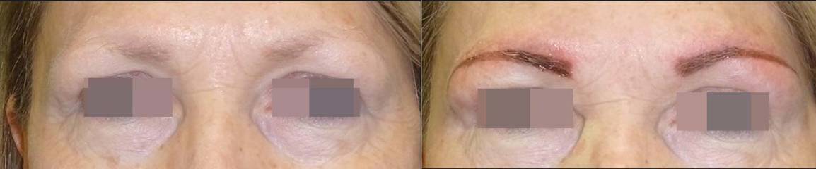 Before and after eyebrow micropigmantation treatment showing newly defined and shaded brows