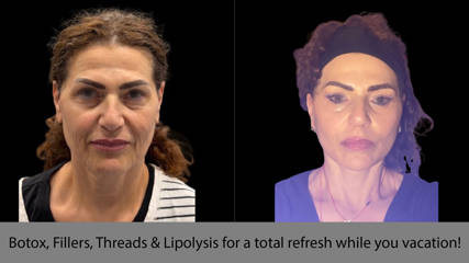 Botox, Fillers, Threads & Lipolysis for a total refresh while you vacation!