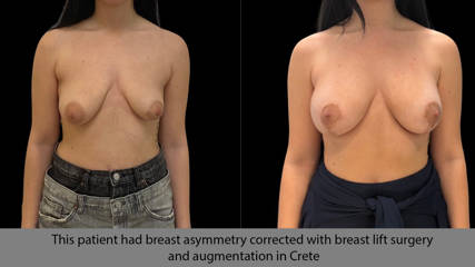 This patient had breast asymmetry corrected with breast lift surgery and augmentation in Crete