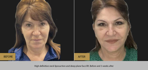 Before and after neck liposuction and deep plane face lift on a woman, showing a smoother jawline and tighter skin