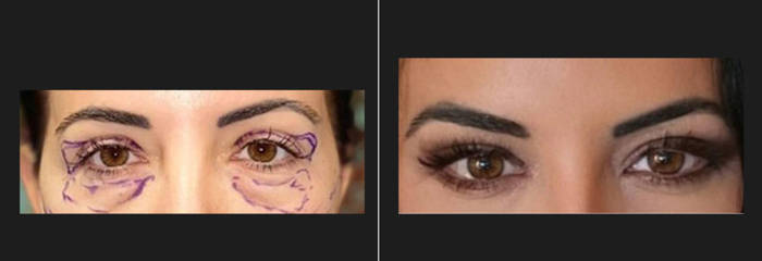 Blepharoplasty64