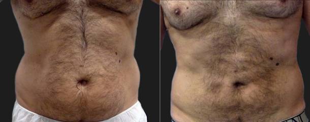 Before and after of a man's abdomen showing noticeable fat reduction and improved contour following liposuction
