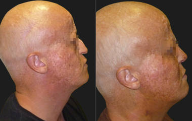 Side view before and after rhinoplasty showing correction of nasal projection and smoother nasal contour