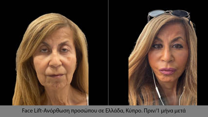 Scarless Face Lift 11