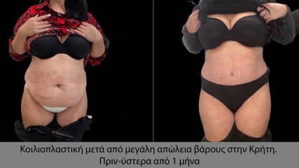 Abdominoplasty10 (1)