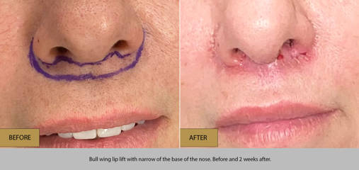 Before and after bull wing lip lift with narrow of base of the nose