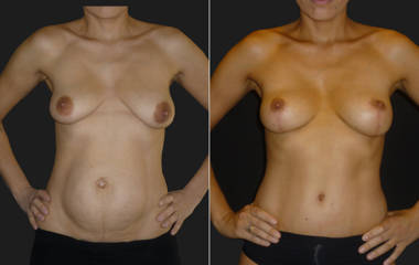 Before and after Mommy Makeover showing restoration with abdominal tightening and breast reshaping