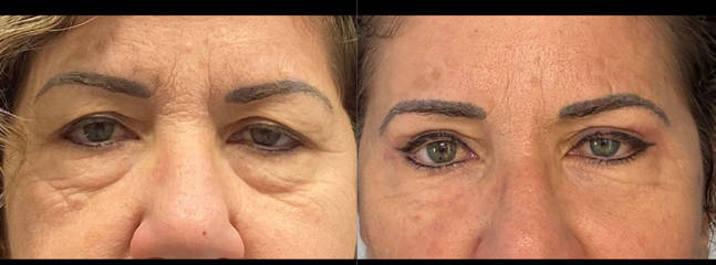Blepharoplasty 75 (1)
