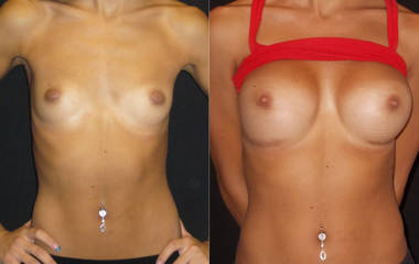 Before and after breast augmentation with silicone implants showing enhanced volume and lifted appearance