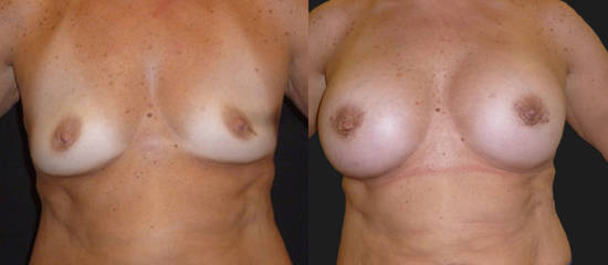 Before and after breast augmentation demonstrating fuller shape and refined contour