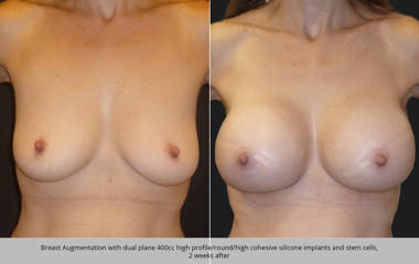 Breast augmentation with dual plane 400cc silicone implants and stem cells, 2 weeks after