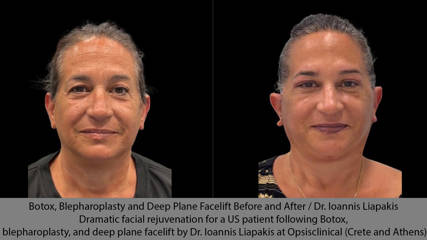 Botox, Blepharoplasty and Deep Plane Facelift Before and After / Dr. Ioannis Liapakis Dramatic facial rejuvenation for a US patient following Botox, blepharoplasty, and deep plane facelift by Dr. Ioannis Liapakis at Opsisclinical (Crete and Athens)