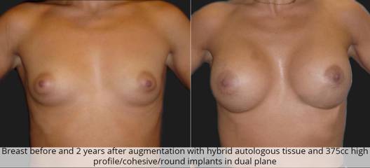 Breast before and 2 years after augmentation with hybrid autologous tissue and 375cc high profile implants