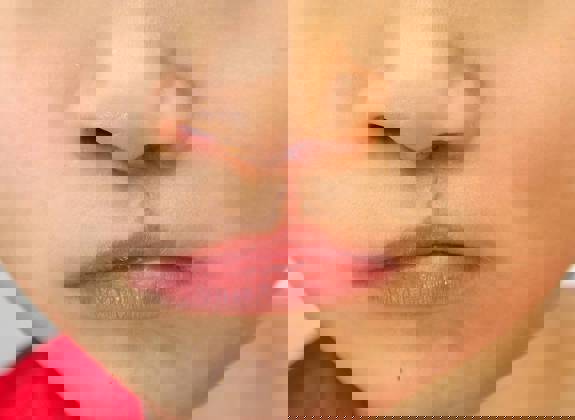 Close up of healed surgical scar on upper lip after cleft lip repair