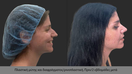 Rhinoplasty80