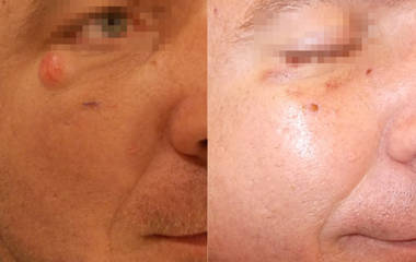 Close up at the side of the eye showing before and after removal of a skin nevus near the eyelid