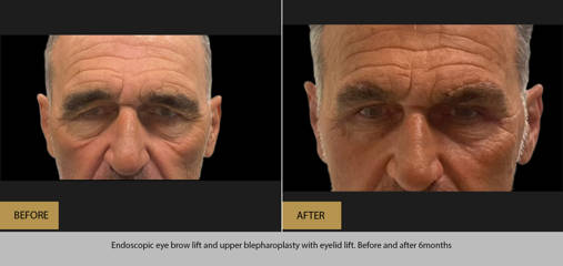 Before and six months after endoscopic eye brow lift and upper blepharoplasty with eyelid lift