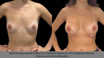 Breast Augmentation96