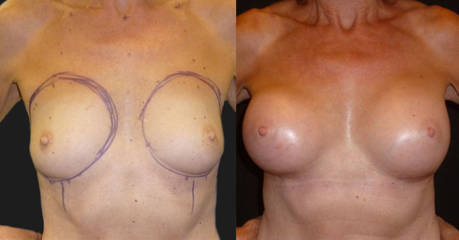 Before and after breast augmentation showing enhanced volume and improved breast contour