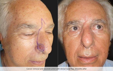 Before and after nasal skin cancer removal and reconstruction using a dorsal nasal flap
