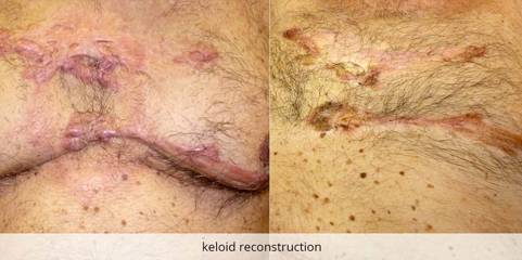 Before and after comparison showing keloid scar reconstruction on the chest, with improved healing and reduced scarring