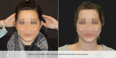 Before and after otoplasty using Mustarde and Furnas sutures showing refined ear position 