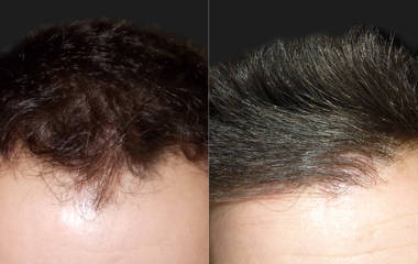 Before and after image of a man received hair transplantation, showing increased hair density