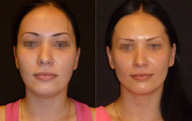Before and after facial liposuction showing improved jawline definition and slimmer face