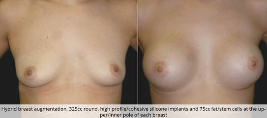 Before and after hybrid breast augmentation, 325cc round, high profile, cohesive silicone implants and 75cc fat