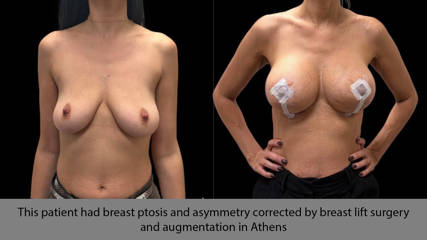 This patient had breast ptosis and asymmetry corrected by breast lift surgery and augmentation in Athens 