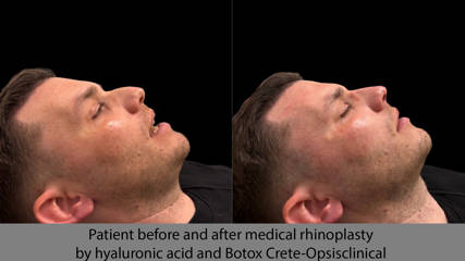 Patient before and after medical rhinoplasty by hyaluronic acid and Botox Crete-Opsisclinical  