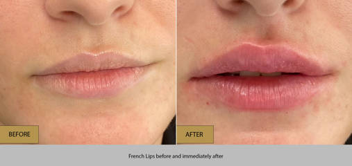Before and after French lip filler treatment showing softly sculpted lips and subtle volume and refined shape