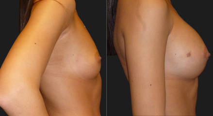 Before and after breast augmentation showing enhanced volume and improved breast contour