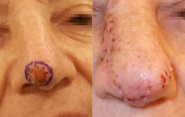 Before and after removal and reconstruction of a skin lesion on the nose, with surgical sutures
